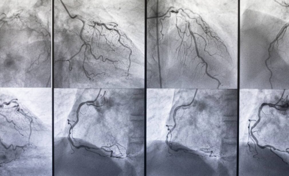 Coronary Angiography (CAG) & PTCA