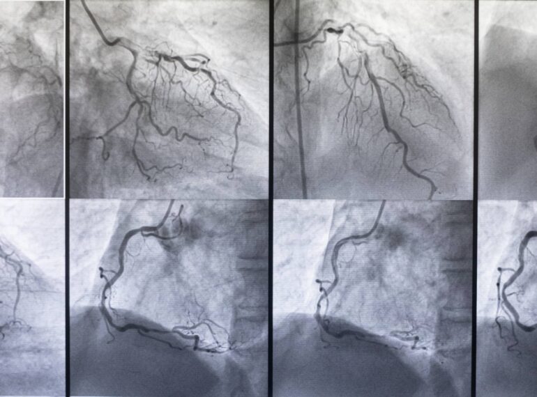 Coronary Angiography (CAG) & PTCA