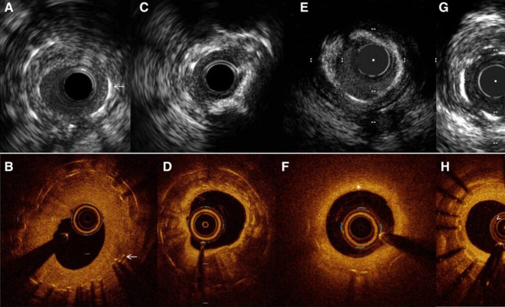 Imaging-Guided Precision PCI with OCT & IVUS