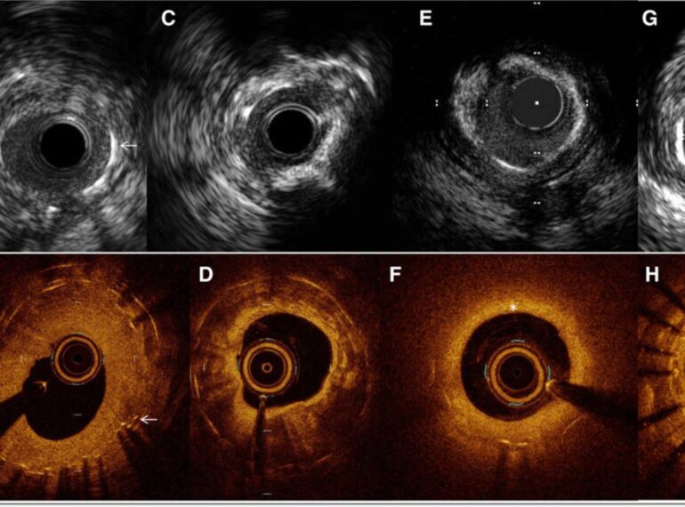 Imaging-Guided Precision PCI with OCT & IVUS