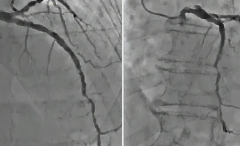 Complex Coronary Lesions Treatment