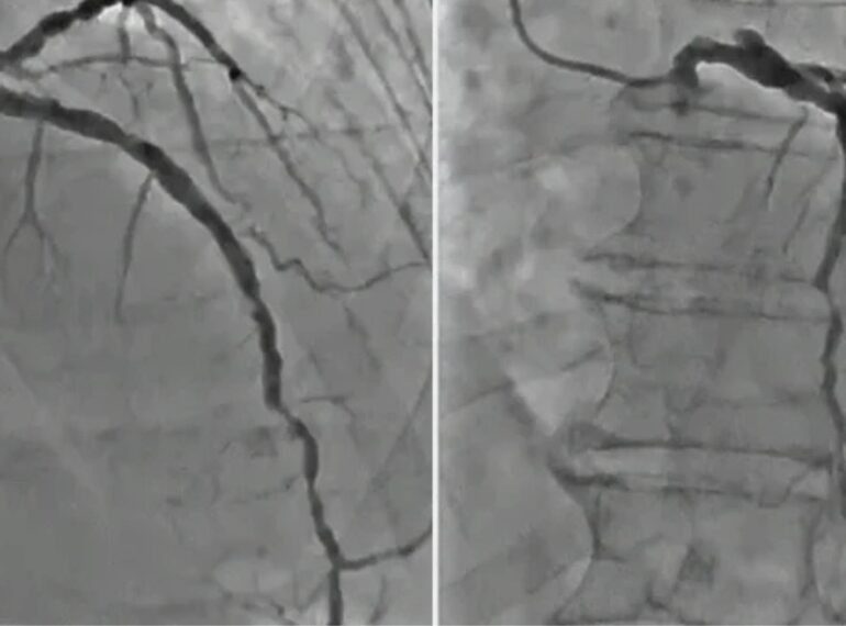 Complex Coronary Lesions Treatment